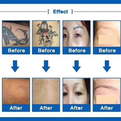 Rimozione 110V/220V della lentiggine della macchina di rimozione del tatuaggio del laser del ND commutata Q Yag